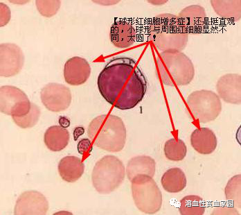 认识疾病｜溶血性贫血之遗传性球形红细胞增多症（HS）